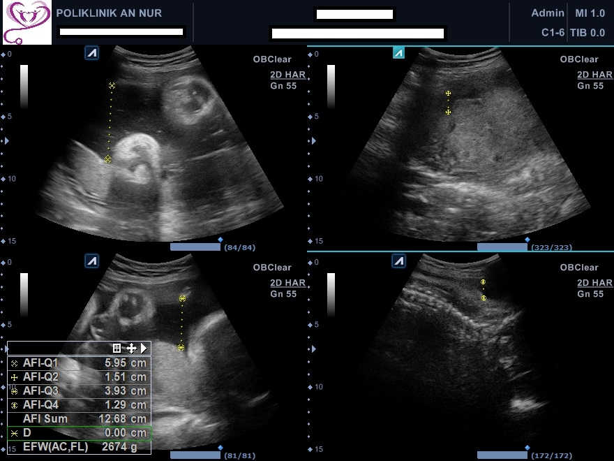 You are currently viewing KEBAIKAN 3D4D SCAN UNTUK IBU HAMIL